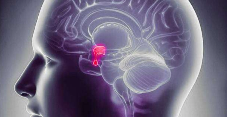 N.D.K, 24j en extreme hypofisetumor 