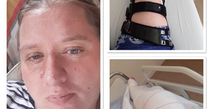 Operatie na meniscus en kruisbanden gescheurd