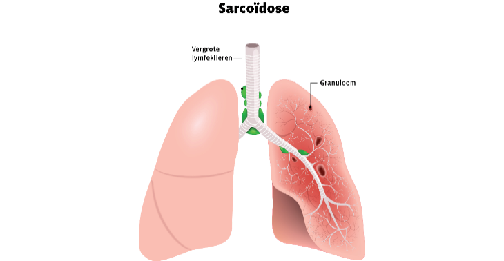 Onderzoek naar sarcoidose 