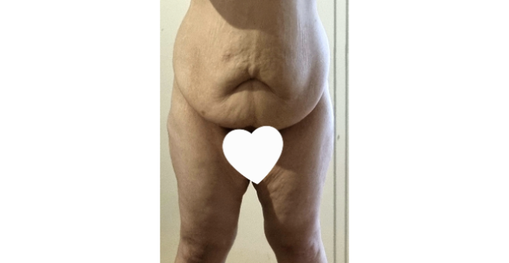 Hulp gevraagd bij een lbl ivm 70 kg afvallen en geen hulp van de verzekerin