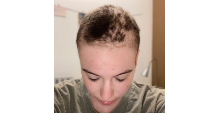 Haarextensions na chemo voor meisje van 23 jaar