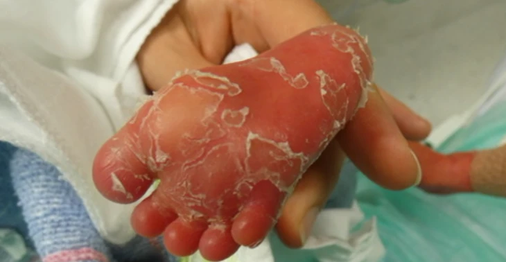 Baby geboren met zeldzame huidziekte