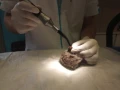 corynebacterie laserbehandeling