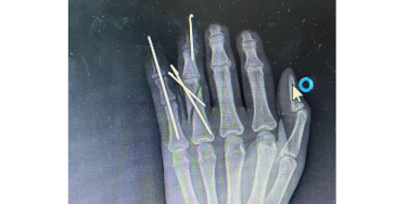 Vor 16Jahren wurde Elyas die Hand gebrochen. Aufgrund einer akuten Infektio