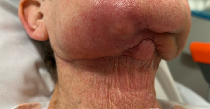 Tumor in kaak