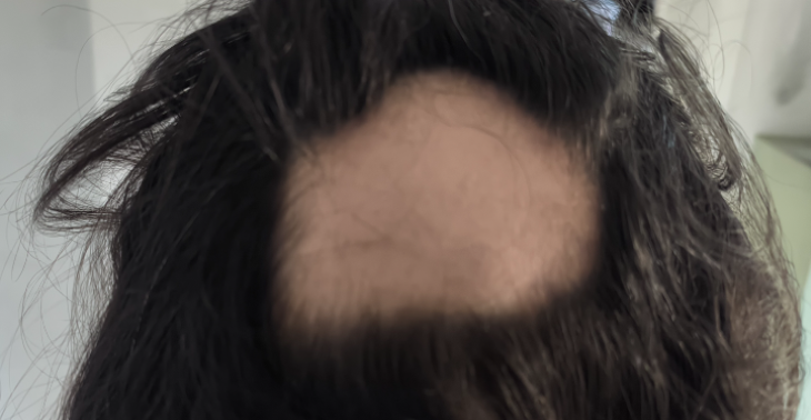 Haartransplantatie