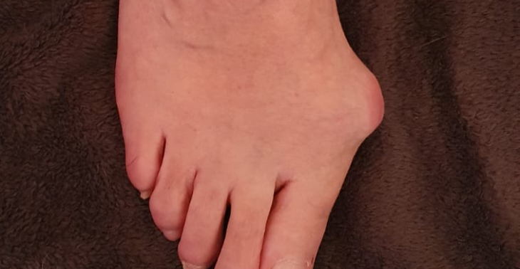 Hallux valgus 