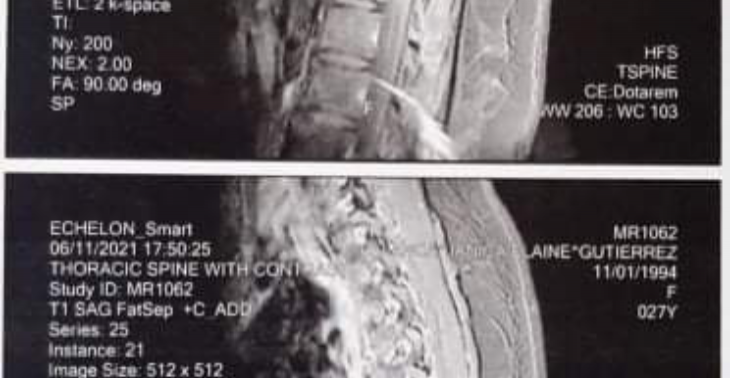 Geld voor operatie “spinal meningiomas” voor goede vriendin