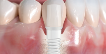 Full dentures Zahnprothese