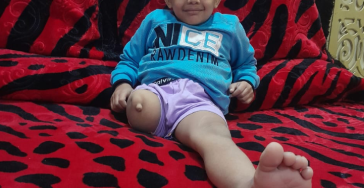 Eine Prothese wird benötigt