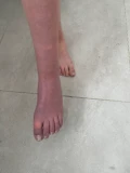 emily   voet crps