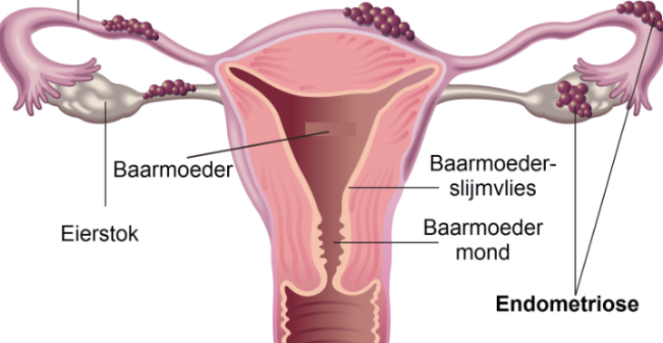 Endometriose