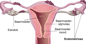 Endometriose