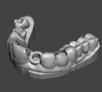 SURGICAL SPLINT FOR GUIDED SURGERY 3D model