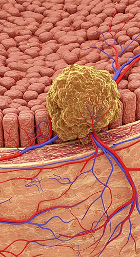 Illustration of a cancer tumor embedded in vascularized tissue — 8K royalty-free microscopic stock photo