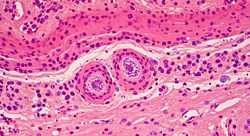 Dermatopathology: squamous epithelium with keratinization and surrounding inflammatory/granulomatous infiltrate — 8K royalty-free microscopic stock photo