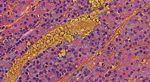 Neuropathology slide illustrating Alzheimer’s disease with amyloid plaques in brain tissue — 8K royalty-free microscopic stock photo