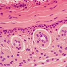 Histology slide of skin showing basal layer abnormalities with nests of round cells in a fibrous dermis, surrounded by connective tissue and inflammatory infiltrate — 2K royalty-free microscopic stock footage