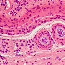 Dermatopathology micrograph illustrating squamous tissue changes with inflammatory infiltrates and vascular structures, highlighting characteristic cellular arrangements and nuclear staining in a skin biopsy sample slide — 2K royalty-free microscopic stock footage