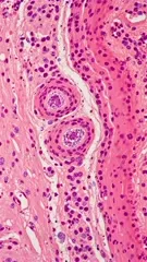 Dermatopathology micrograph highlighting squamous architecture in skin tissue, with inflammatory cells and vascular structures, illustrating cellular detail and tissue organization typical of a cutaneous lesion — 4K royalty-free microscopic stock footage