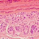 Histology slide from dermatopathology showing lichen planus features: irregular sawtooth epidermal rete ridges, hypergranulosis, and a dense band-like lymphocytic infiltrate obscuring the dermal-epidermal junction, with interface changes — 2K royalty-free microscopic stock footage