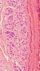 Dermatopathology micrograph of skin showing inflammatory changes consistent with lichen planus, featuring epidermal interface dermatitis, sawtoothing rete ridges, and dense dermal inflammatory infiltrate, characteristic basal vacuolization — 4K royalty-free microscopic stock footage