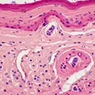 Histological view of skin showing thickened epidermis with adjacent dermal inflammatory infiltrate around a hair follicle, revealing dilated vessels, collagen remodeling, and scattered nuclei consistent with dermatitis — 2K royalty-free microscopic stock footage