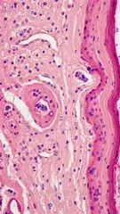 Microscopic skin section from vitiligo showing melanocyte loss and pigment-free epidermis with scattered inflammatory cells in the dermis, basal layer disruption, and altered collagen consistent with vitiligo pathology — 4K royalty-free microscopic stock footage