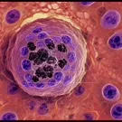 Microscopic view of cancerous cells clustering into a tumor, showing darkly stained nuclei amid lighter cytoplasm and surrounding tissue, highlighting cellular diversity and malignant features seen in cancer — 2K royalty-free microscopic stock footage
