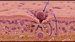 A high-fidelity cross-section of melanoma invading skin, showing a tumor cell breaching the epidermis, with nearby blood vessels and surrounding tissue remodeling — 4K royalty-free microscopic stock footage