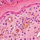 Histopathologic image of dermal inflammation showing eosinophils and lymphocytes amid disrupted collagen and blood vessels, consistent with dermatitis characterized by eczema-like inflammatory infiltrates in the superficial to mid-dermis — 2K royalty-free microscopic stock footage