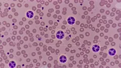 A microscopic blood smear showing numerous pinkish red blood cells with scattered purple-stained white cells, including multinucleated granulocytes, highlighting cellular diversity and potential hematologic abnormalities — 4K royalty-free microscopic stock footage