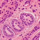 Histopathology micrograph of prostate tissue showing tubular glands with cuboidal to columnar epithelium, arranged in acini within fibromuscular stroma; classic microscopic features used for diagnostic evaluation — 2K royalty-free microscopic stock footage