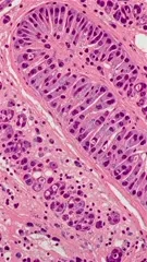 Kidney histopathology showing dilated tubules with vacuolated, columnar epithelial cells, prominent nuclei, and interstitial inflammatory infiltrates, consistent with acute tubular injury — 4K royalty-free microscopic stock footage