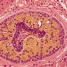 Tuberculosis-related granulomatous tissue section showing scattered macrophages, epithelioid cells, and multinucleated giant cells surrounding a necrotic core, highlighting classic caseous appearance and inflammatory infiltrate within surrounding tissue matrix — 2K royalty-free microscopic stock footage
