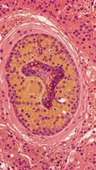 Microscopic image showing a tuberculosis granuloma with lipid-rich macrophages, central caseation, and lymphocytic rim, illustrating granulomatous inflammation typical of infectious TB in lung tissue, characterized by sequestration of necrotic tissue — 4K royalty-free microscopic stock footage