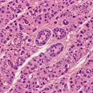 Microscopic view of liver tissue showing hepatitis-related changes: inflamed portal tracts, hepatocellular degeneration, and scattered apoptotic bodies within pink-stained hepatic parenchyma — 2K royalty-free microscopic stock footage