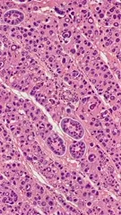 Microscopic liver tissue section showing hepatocytes with vacuolated cytoplasm, inflammatory infiltrates, and portal areas, highlighting cellular changes typical of infectious hepatitis, including periportal inflammation and hepatocellular necrosis — 4K royalty-free microscopic stock footage