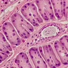 A microscopic view of schistosoma-related tissue infection, showing intestinal epithelial cells and a schistosome egg with surrounding inflammatory response in host tissue during infectious process — 2K royalty-free microscopic stock footage