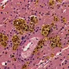 Histological image of brain tissue showing amyloid plaques and neurofibrillary tangles with purple-stained neurons, illustrating characteristic neuropathology of Alzheimer's disease in the hippocampal region and surrounding cortex — 2K royalty-free microscopic stock footage