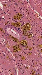 Microscopic view of neuropathology showing clustered brown amyloid-like deposits amid purple-stained neural tissue, highlighting neuronal loss and vessel changes typical of neurodegenerative disease, often associated with Alzheimer's pathology — 4K royalty-free microscopic stock footage