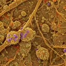 Micrograph depicts neural tissue with Parkinson-related pathology, showing aggregates and cellular structures at high magnification, illustrating neuropathological features such as abnormal protein clumps and tangled networks — 2K royalty-free microscopic stock footage