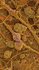 High magnification micrograph of brain tissue revealing tangled neural processes, purple-stained cell nuclei and clustered plaques, illustrating neuropathological features associated with Parkinson’s disease and neurodegenerative decline — 4K royalty-free microscopic stock footage