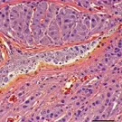 Microscopic view of neural tissue displaying demyelinated areas and inflammatory infiltrates characteristic of multiple sclerosis, with scattered oligodendrocyte loss and microglial activation in a neuropathology specimen — 2K royalty-free microscopic stock footage