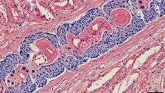 Micrograph of spinal cord tissue highlighting neuropathologic changes: dense blue nuclei in glial and inflammatory cells amid pink connective tissue with folded neuropil and vascular features visible — 4K royalty-free microscopic stock footage