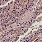Histology image of neuroblastoma with small round blue tumor cells, brown immunostaining highlighting tumor elements amid surrounding stroma and endothelial spaces — 2K royalty-free microscopic stock footage