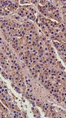 Histological section showing neuroblastoma-compatible cells with brown immunostaining and blue nuclei, highlighting cellular morphology and tumor microenvironment in a neuropathology context for diagnostic insight and research — 4K royalty-free microscopic stock footage