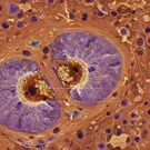 Micrograph of stained tissue revealing rounded purple cells with dark nuclei embedded in a brown extracellular matrix and fiber networks, illustrating cellular arrangement and tissue architecture at high magnification — 2K royalty-free microscopic stock footage