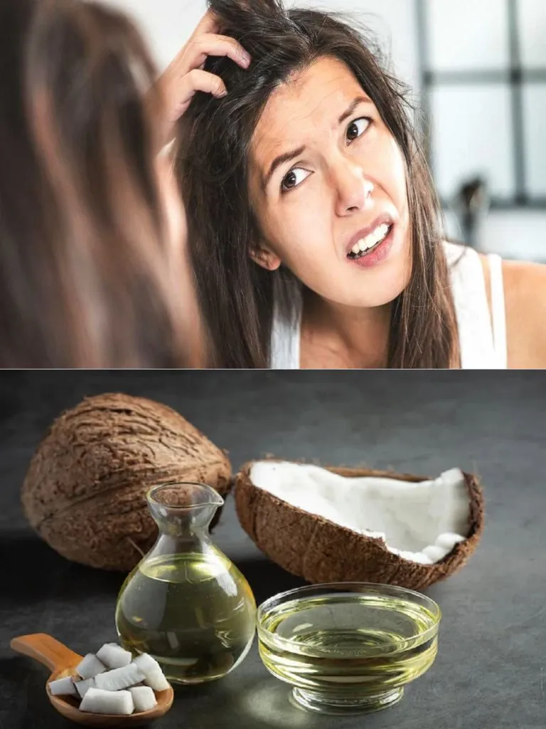 Hair Care Tips: डैंड्रफ से हैं परेशान? नारियल तेल में मिलाकर लगाएं ये चीज, चुटकियों में होगा ठीक