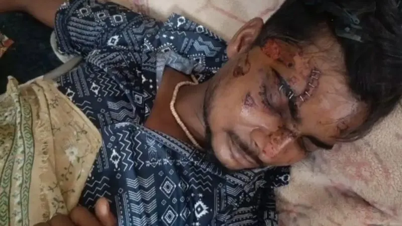 aligarh-motorola-phone-blast-in-pocket-injures-delivery-boy